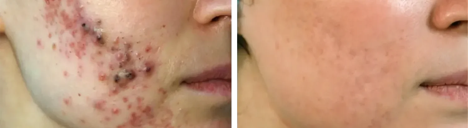 advanced-reupload-michael-gold-before-and-after-1536x744-1