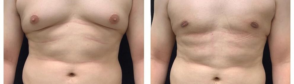 GYNECOMASTIA-male-before-after