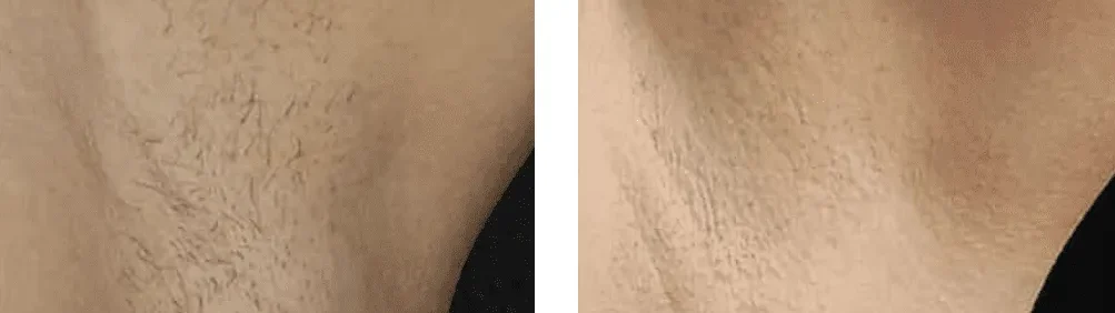 laser-hair-removal-before-after-1