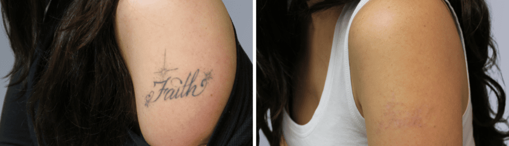 pico-for-tattoo-1024x631