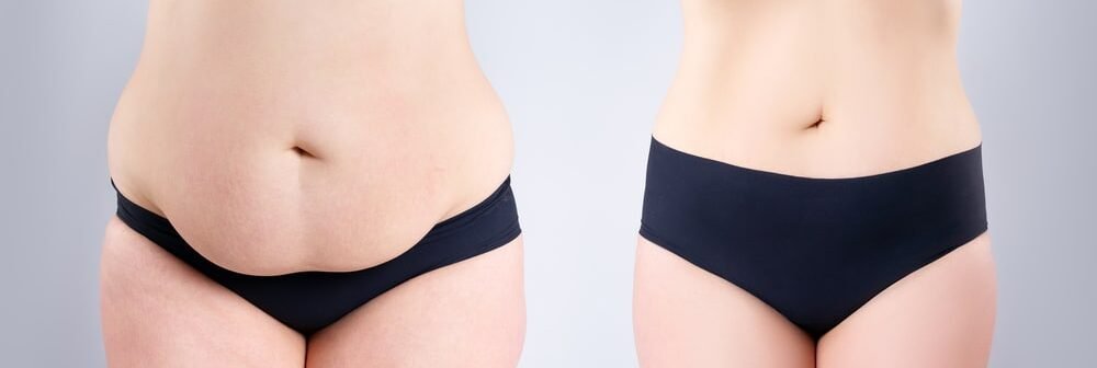 Woman's belly before and after weight loss on gray background, plastic surgery concept
